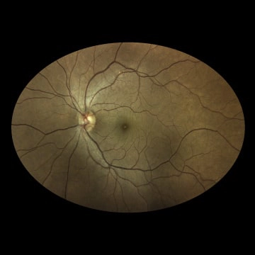 Normal-Retina