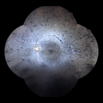 Retinitis-Pigmentosa